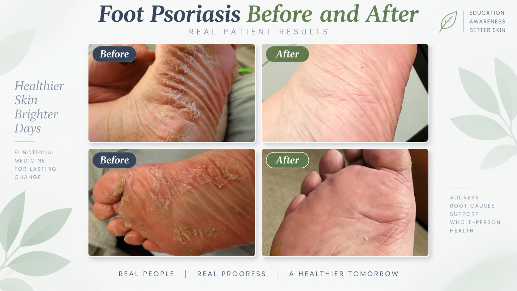 Functional Medicine for Foot Psoriasis