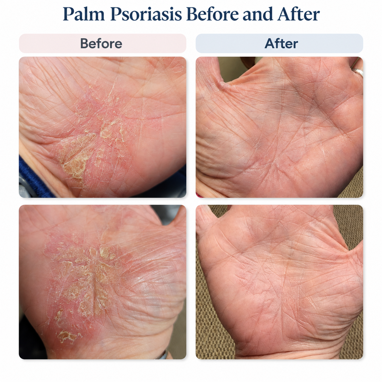 Functional Medicine for Hand Psoriasis