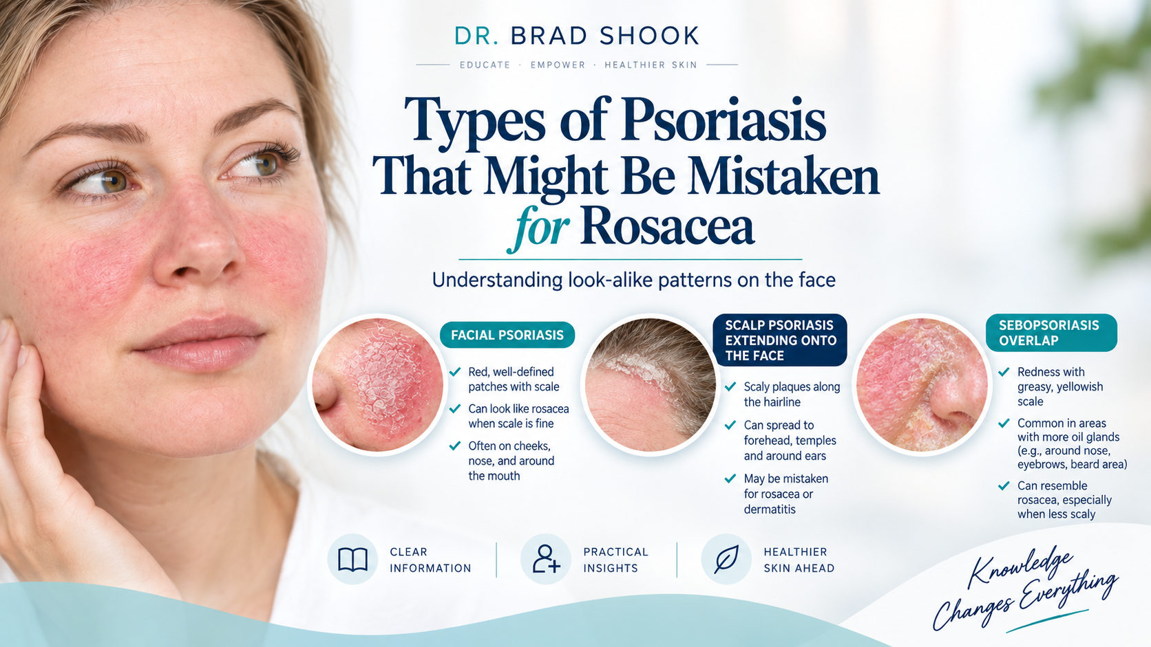 Types of psoriasis that might be mistaken for rosacea