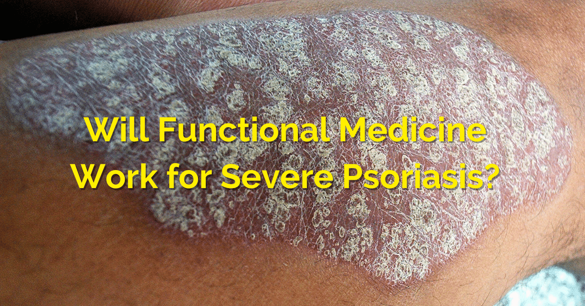 FM for Severe Psoriasis 2