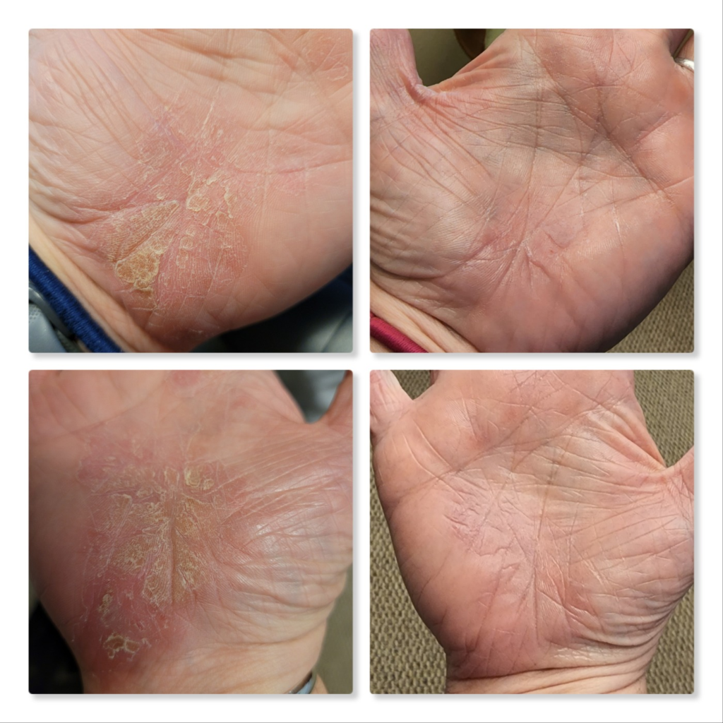 Functional Medicine for Hand Psoriasis