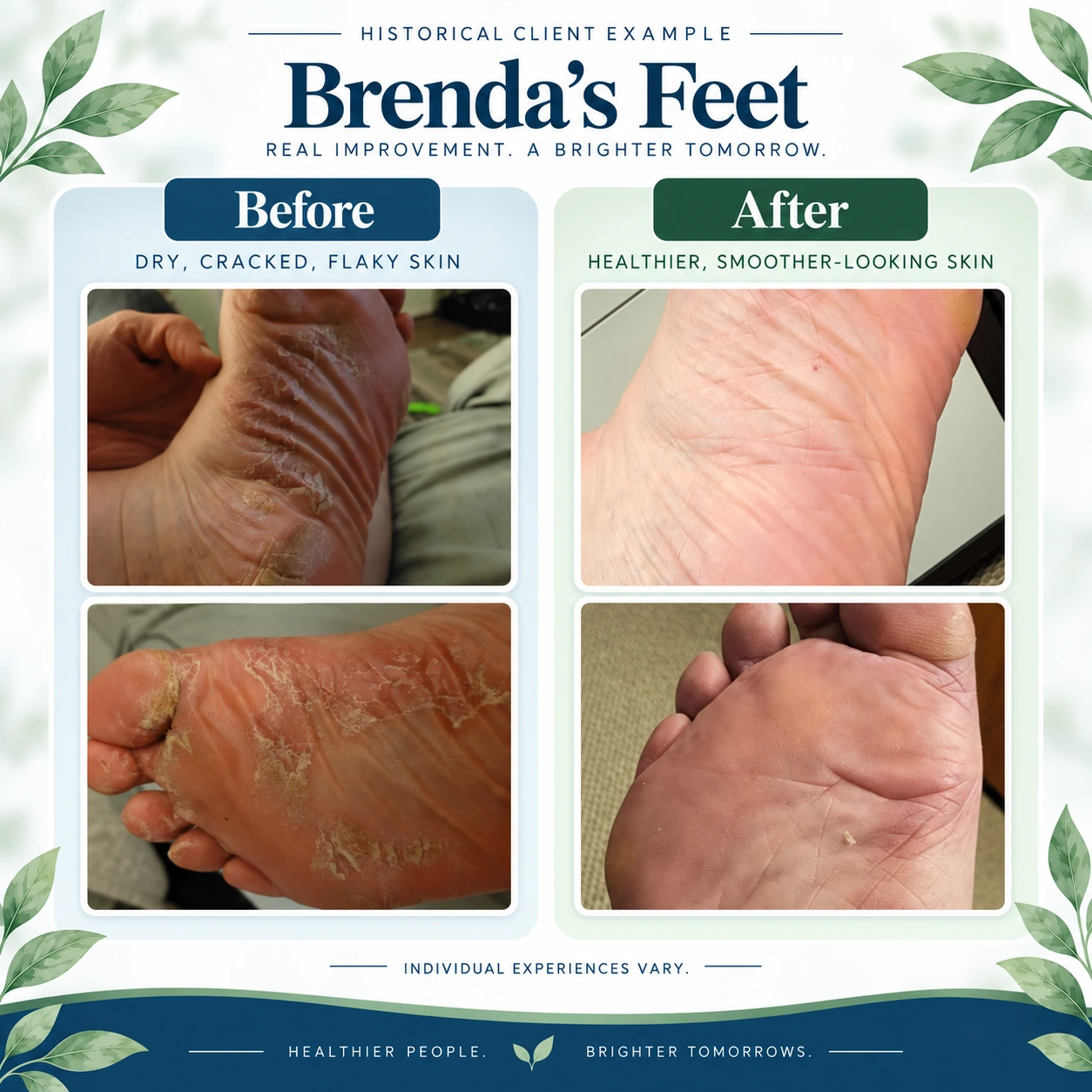 Historical before-and-after photographs of psoriasis affecting a client's feet