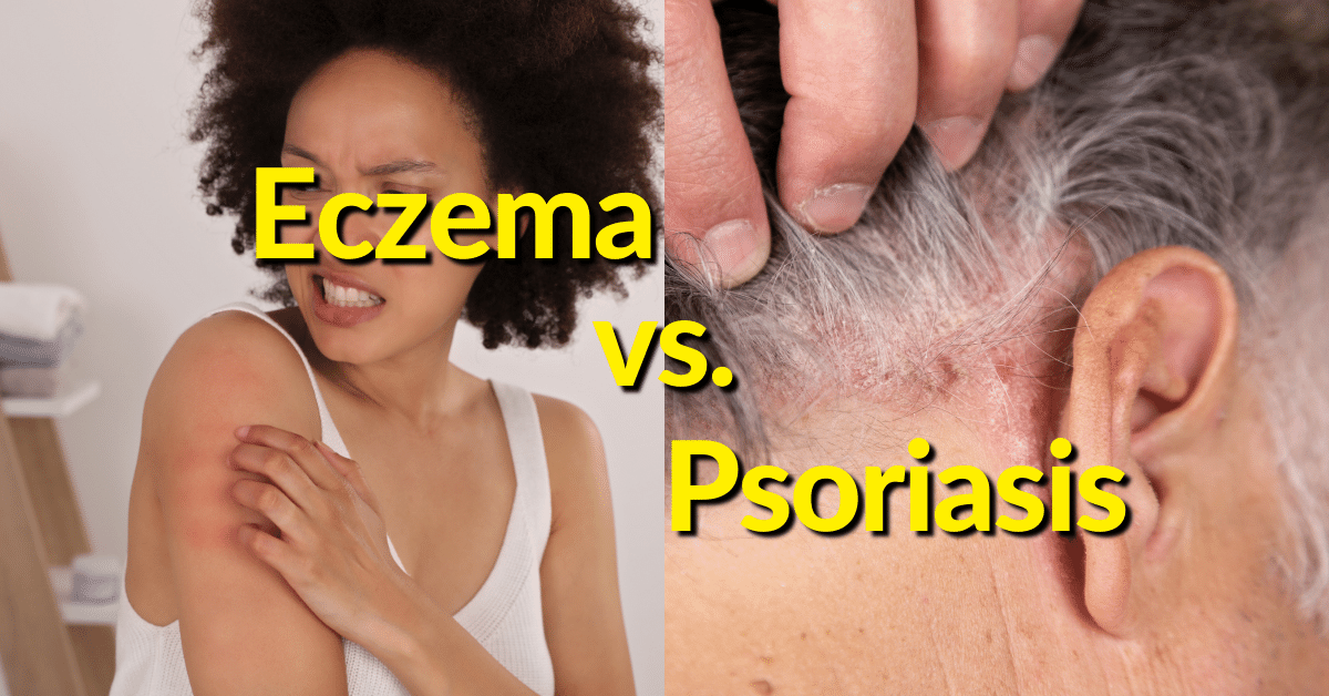 These two skin diseases present slightly different on affected skin tissue. Learn the difference between eczema and psoriasis. 