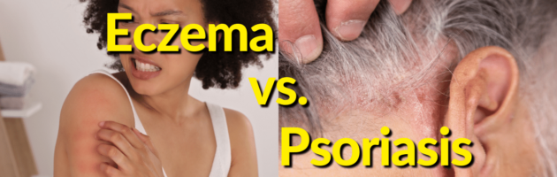 Psoriasis and eczema