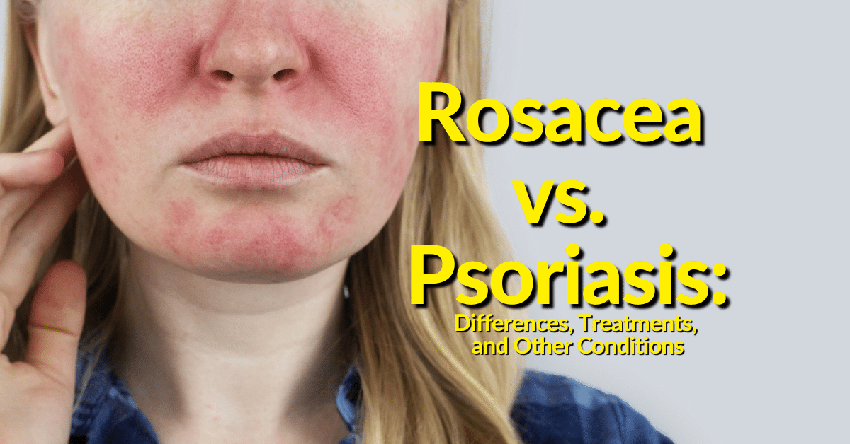 mild psoriasis on face