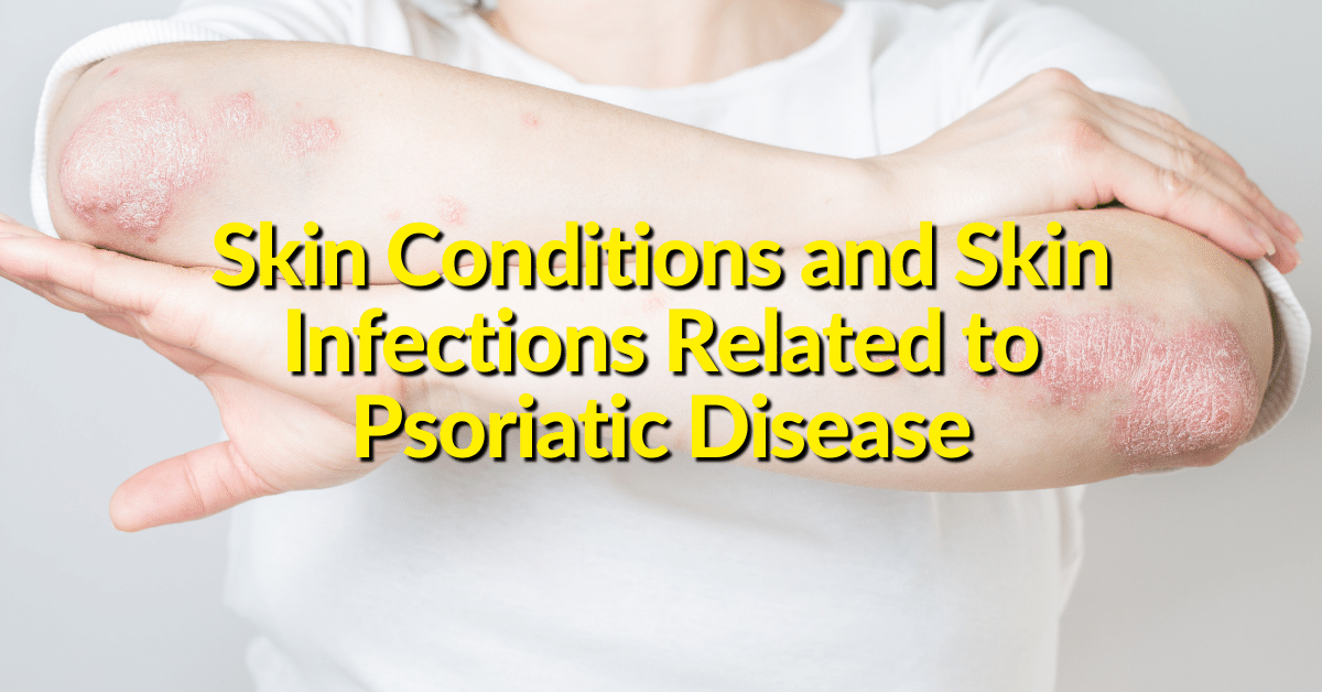 Injury or illness can trigger flares for those who have been diagnosed with psoriatic arthritis.