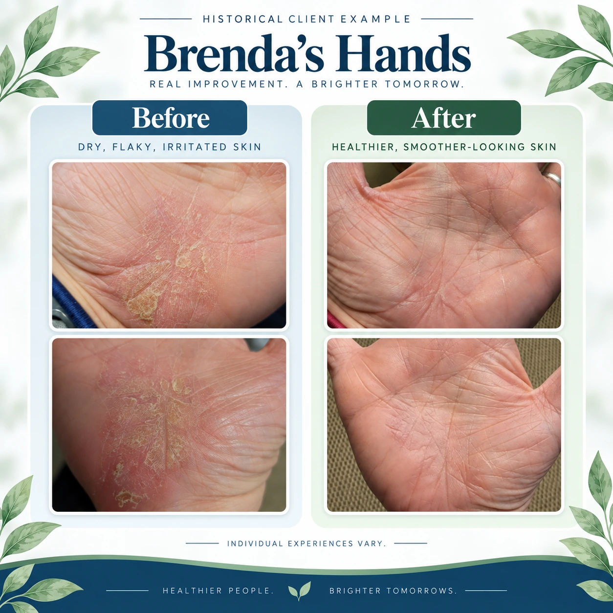 Historical before-and-after photographs of psoriasis affecting a client's hands