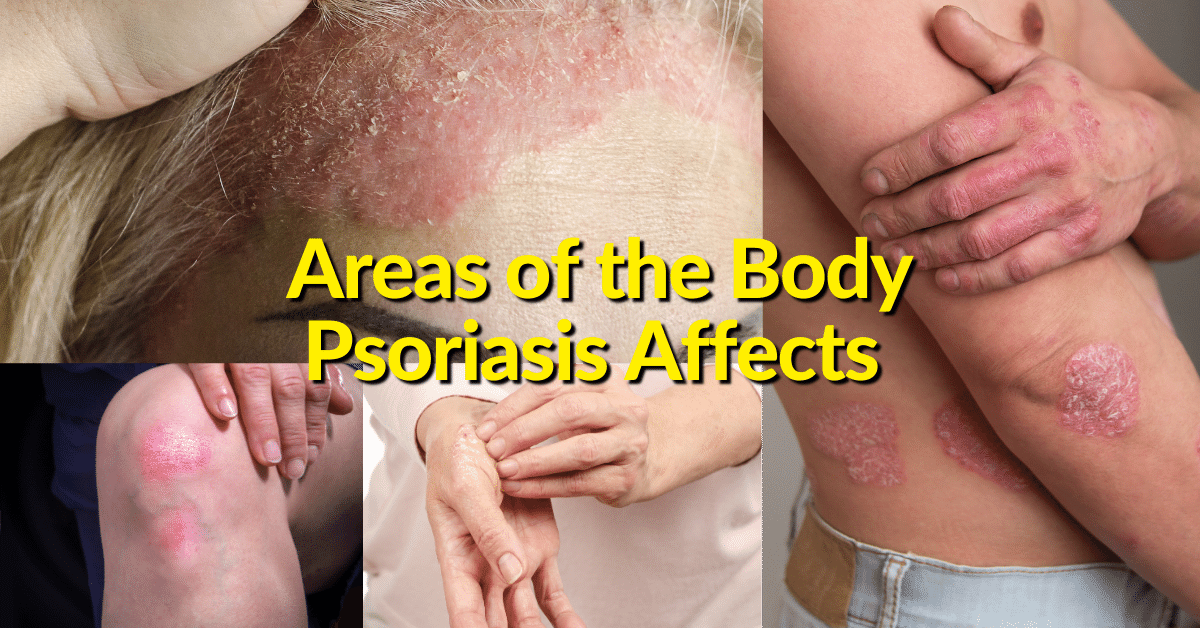 Prevent psoriasis inflammation by getting your psoriasis diagnosed through physical examination by a healthcare professional if you have scaly patches 