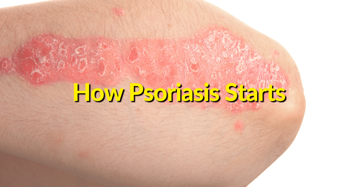 Common occurrences that trigger psoriasis symptoms in those with psoriatic disease range from cold weather to common infections that can also worsen symptoms. 