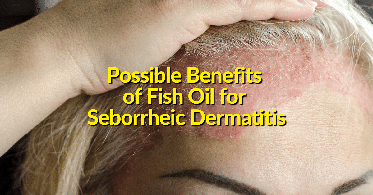 Evidence suggests that fish oil may be a good complementary treatment to improve symptoms of seborrheic dermatitis? 