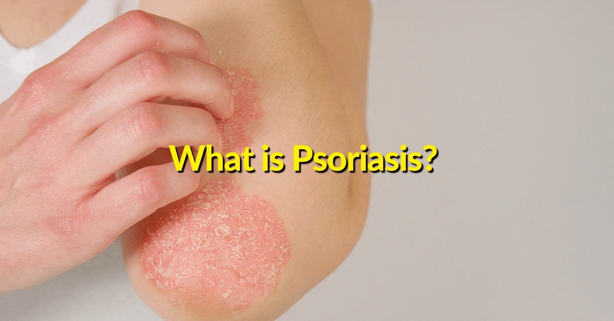 Collagen is one of the complementary and alternative therapies used to treat psoriasis symptoms and help with healing psoriasis in addition to topical creams and a healthy diet. 
