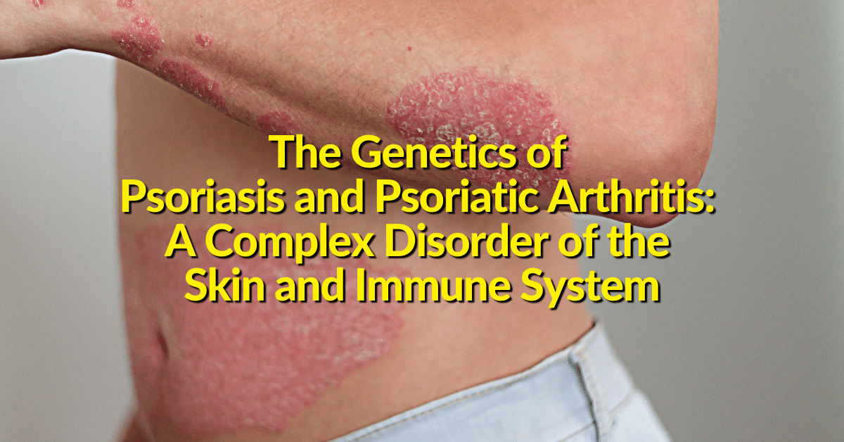 Plaque Psoriasis and Psoriatic Arthritis, a common and complex disease, can be caused by genetic factors at play, but also have environmental trigger factors.  