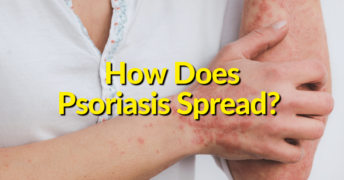Excessive skin cell growth caused by PsO is not contagious.  However, it can spread to other parts of the body where dead skin cells tend to accumulate. 