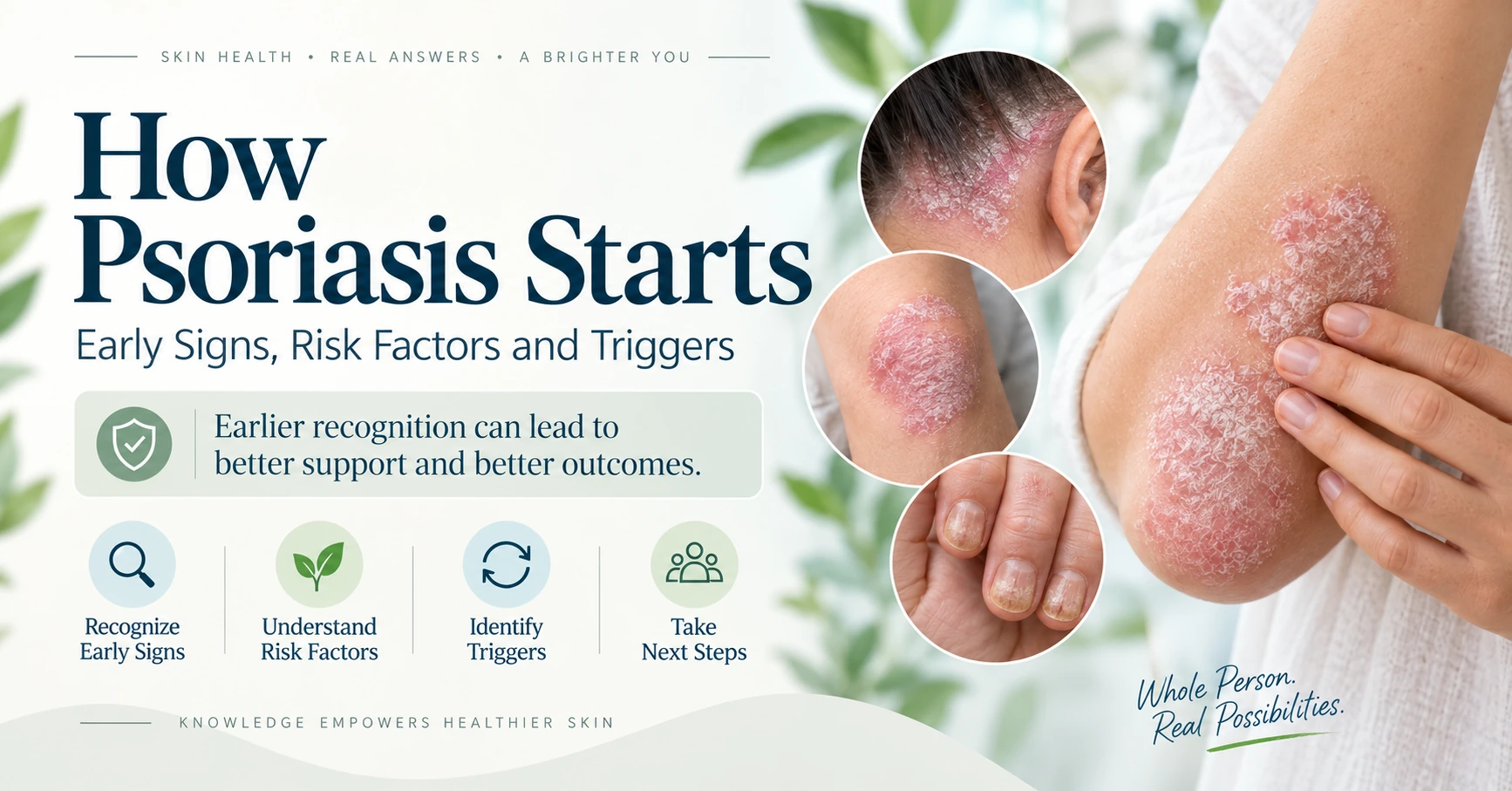 Early psoriasis signs on common body areas across varied skin tones