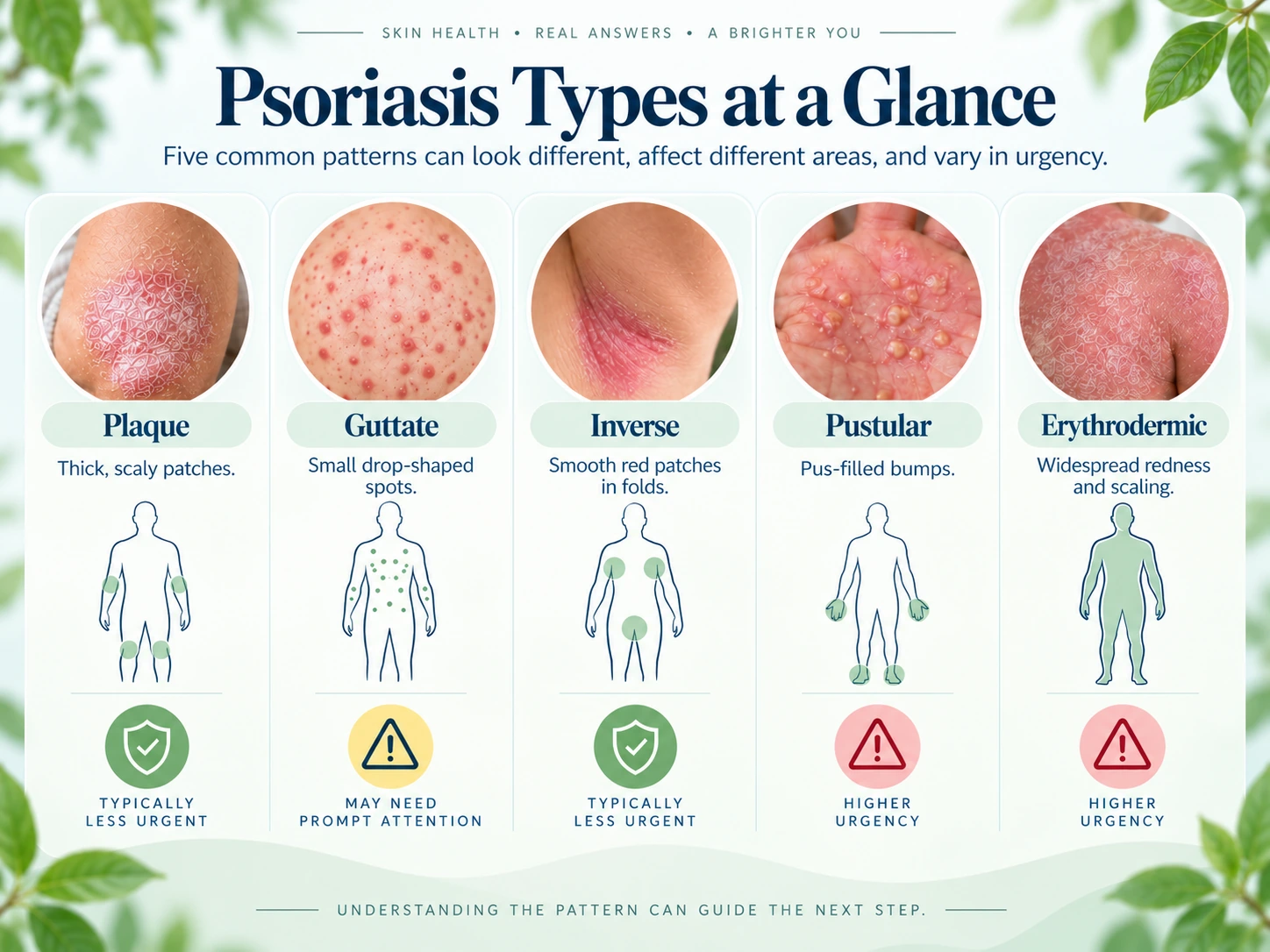 Comparison chart of psoriasis types by appearance, common locations, tempo, and urgency
