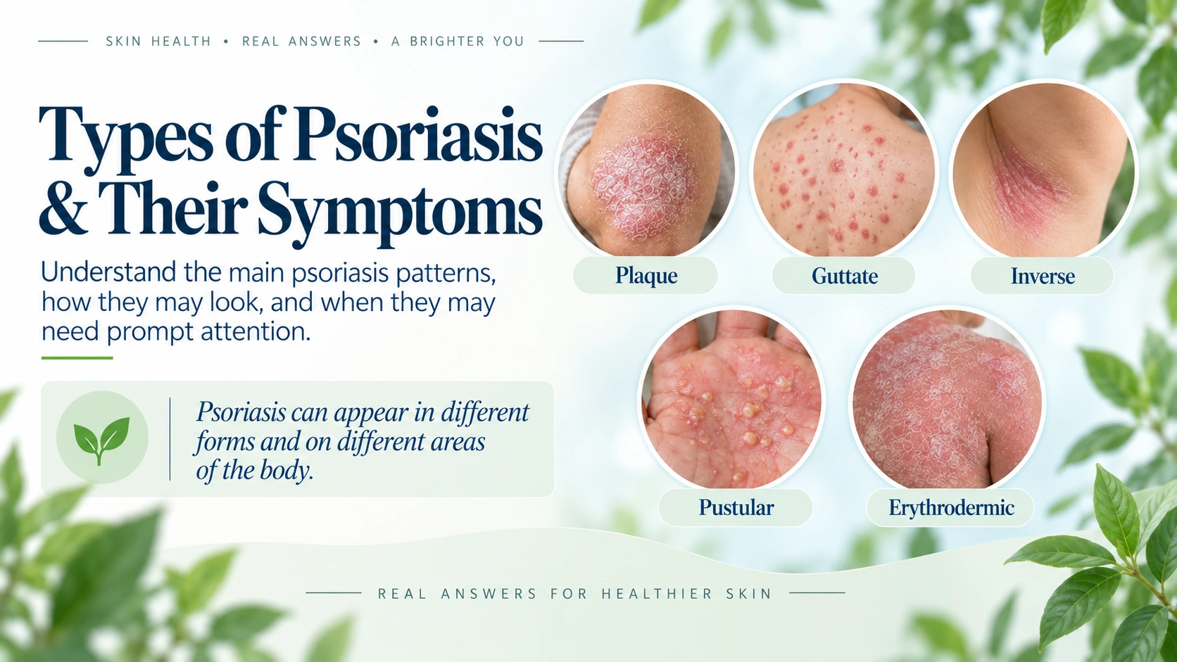 Overview of plaque, guttate, inverse, pustular, and erythrodermic psoriasis across varied skin tones
